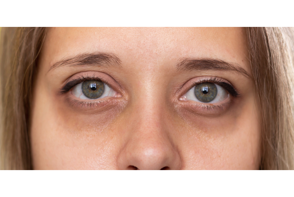 Cernes sous les yeux : comment les anticiper et y remédier ?